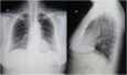 体检胸片没见异常，CT却看到了肺癌！怎么回事?