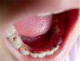 第四次口腔健康调查：我国儿童龋病流行低