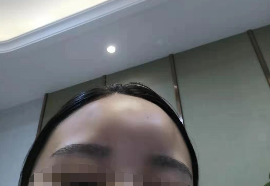 郑州华领医疗美容医院：大学生注射玻尿酸额头鼓起一个“大包” 二次美容手术后鼓包更大